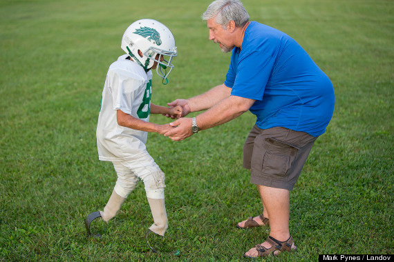 Deven learns to run with his new prosthetics-inspireMore