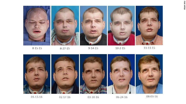 160824111713-08-face-transplant-patrick-hardison-update-exlarge-169