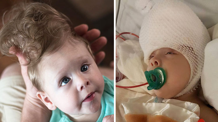 baby with brain outside of skull goes through surgery