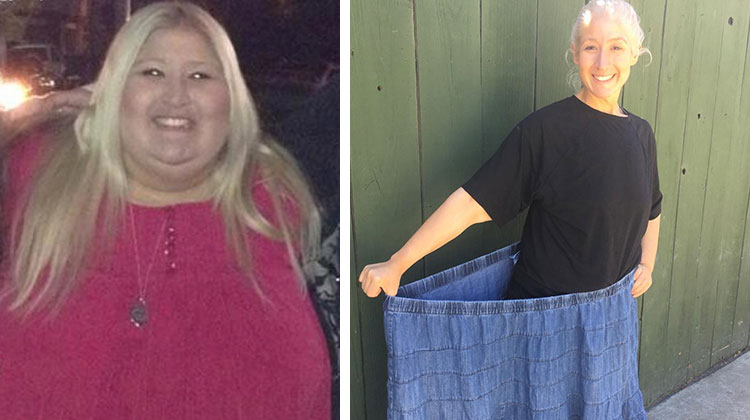woman before and after losing 350 pounds