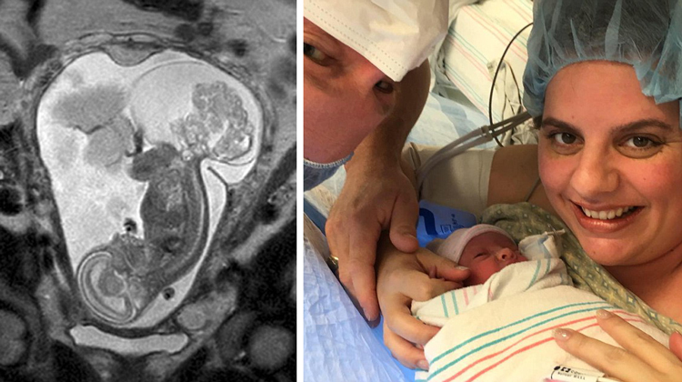 sonogram of baby with tumor and parents holding baby after birth in hospital