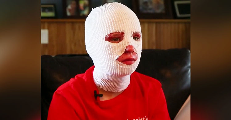 girl with bandages on face