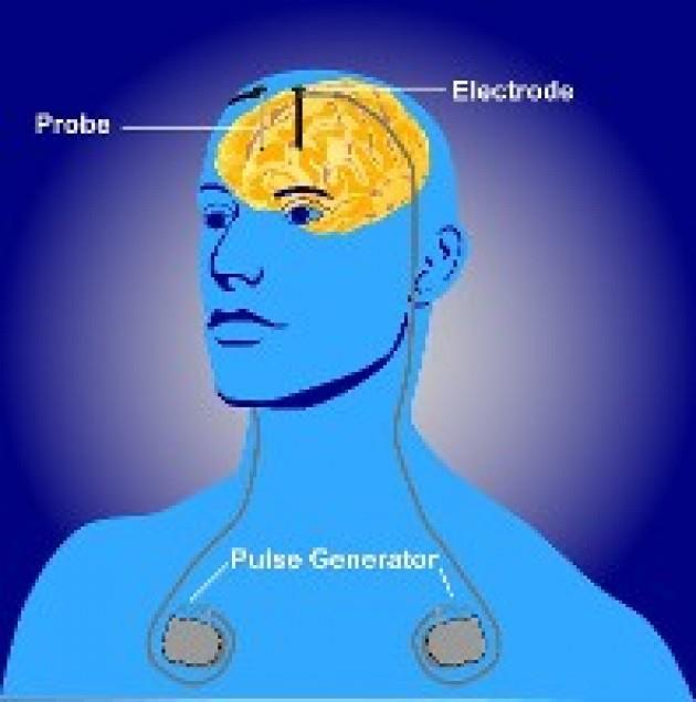 deep brain stimulation