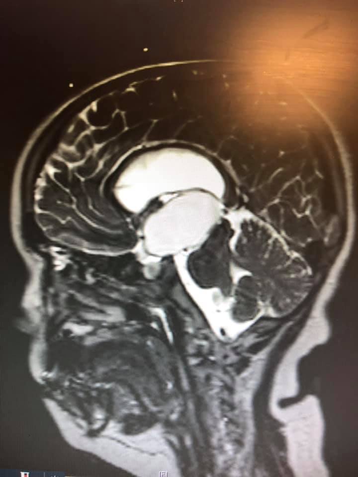 danny brain tumor