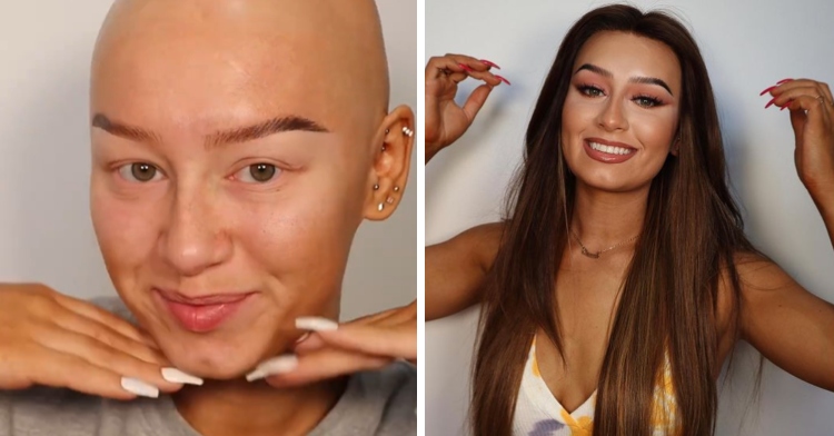 influencer with alopecia