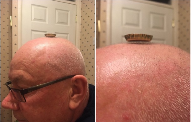 a bottle cap hovering on the nearly invisible hairs on a man's head