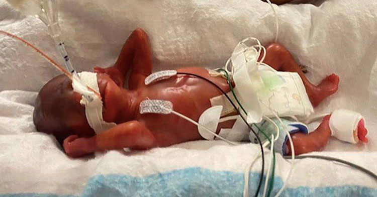 tiny preemie hooked up to wires in hospital