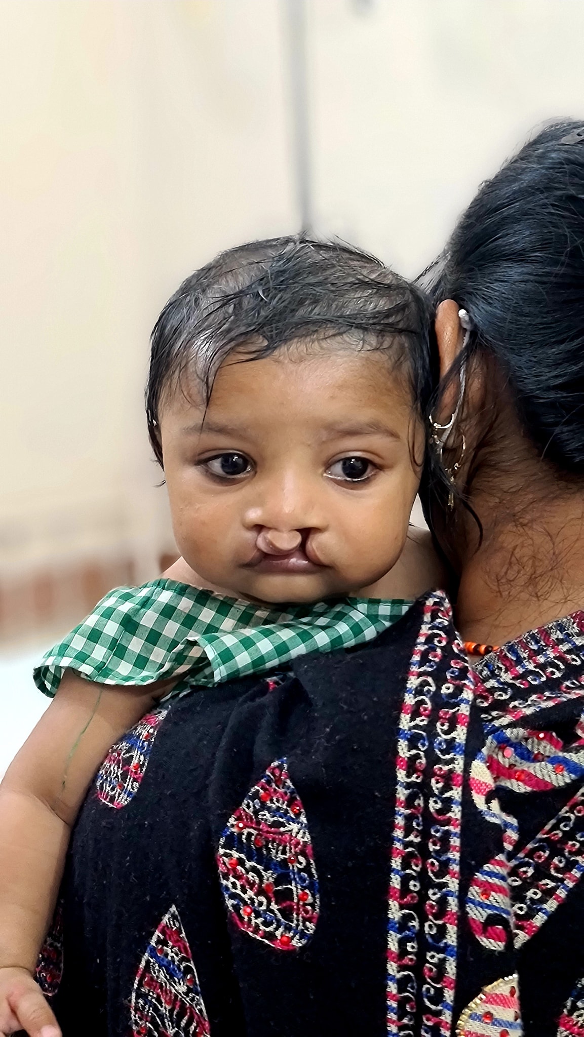 child with cleft palate