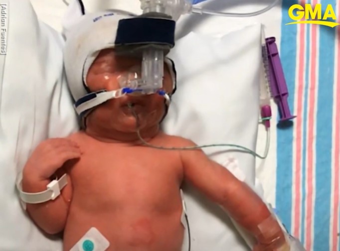 newborn baby named enzo laying down with tubes attached to his nose
