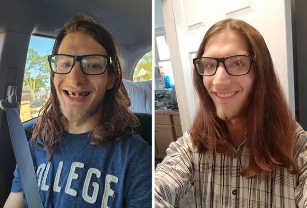 before and after of young man with dentures
