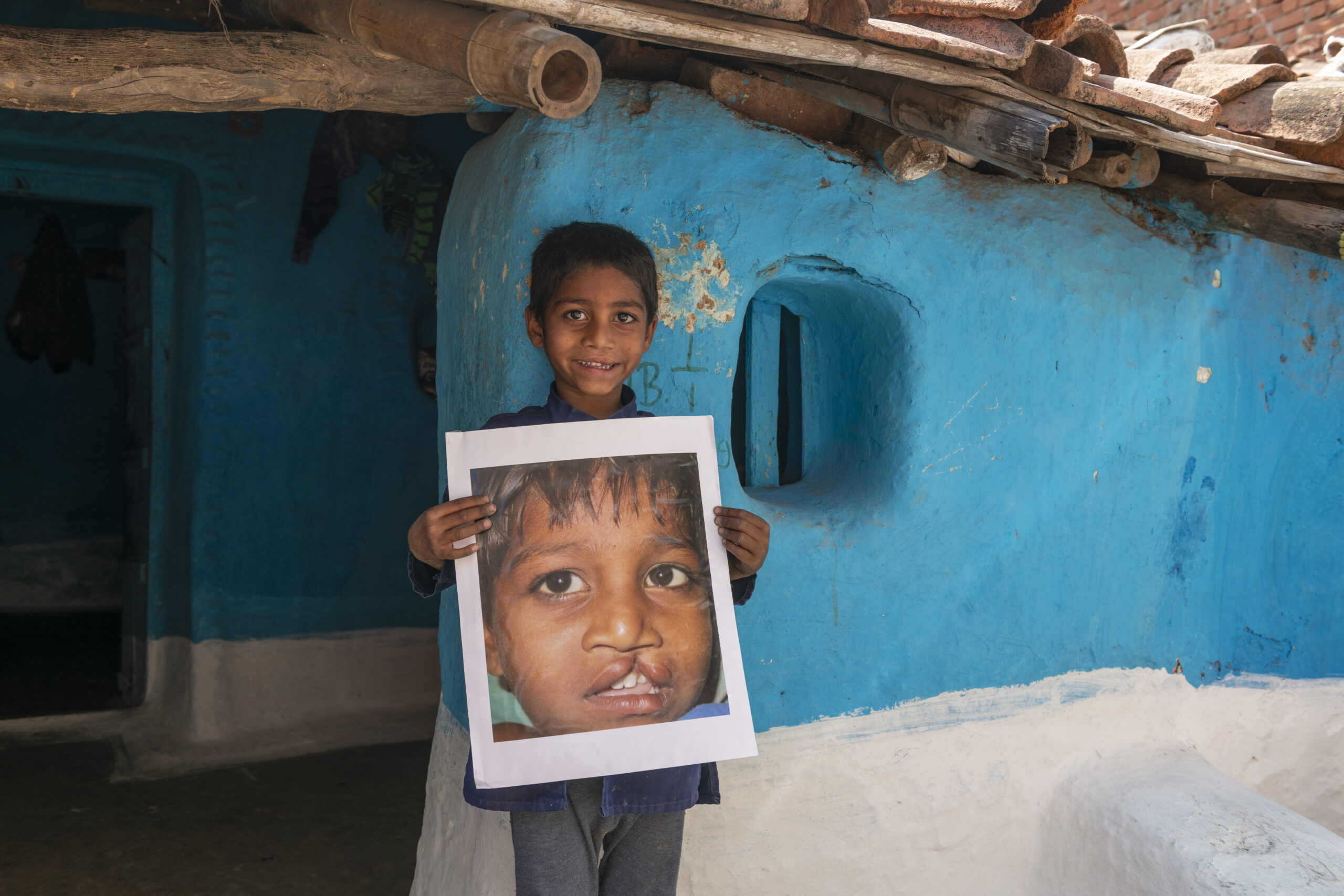 little boy holding photo of himself as child with a cleft