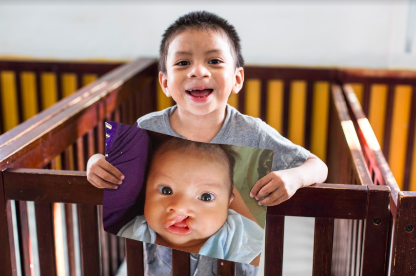 auner little boy holding picture of himself with cleft as baby