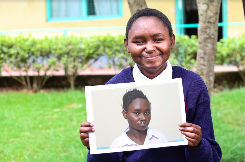 girl holding picture of herself with a cleft