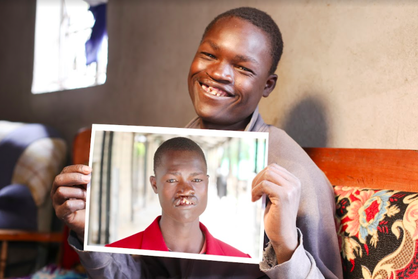 man holding picture of himself with a cleft