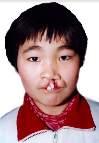 little girl with a cleft 
