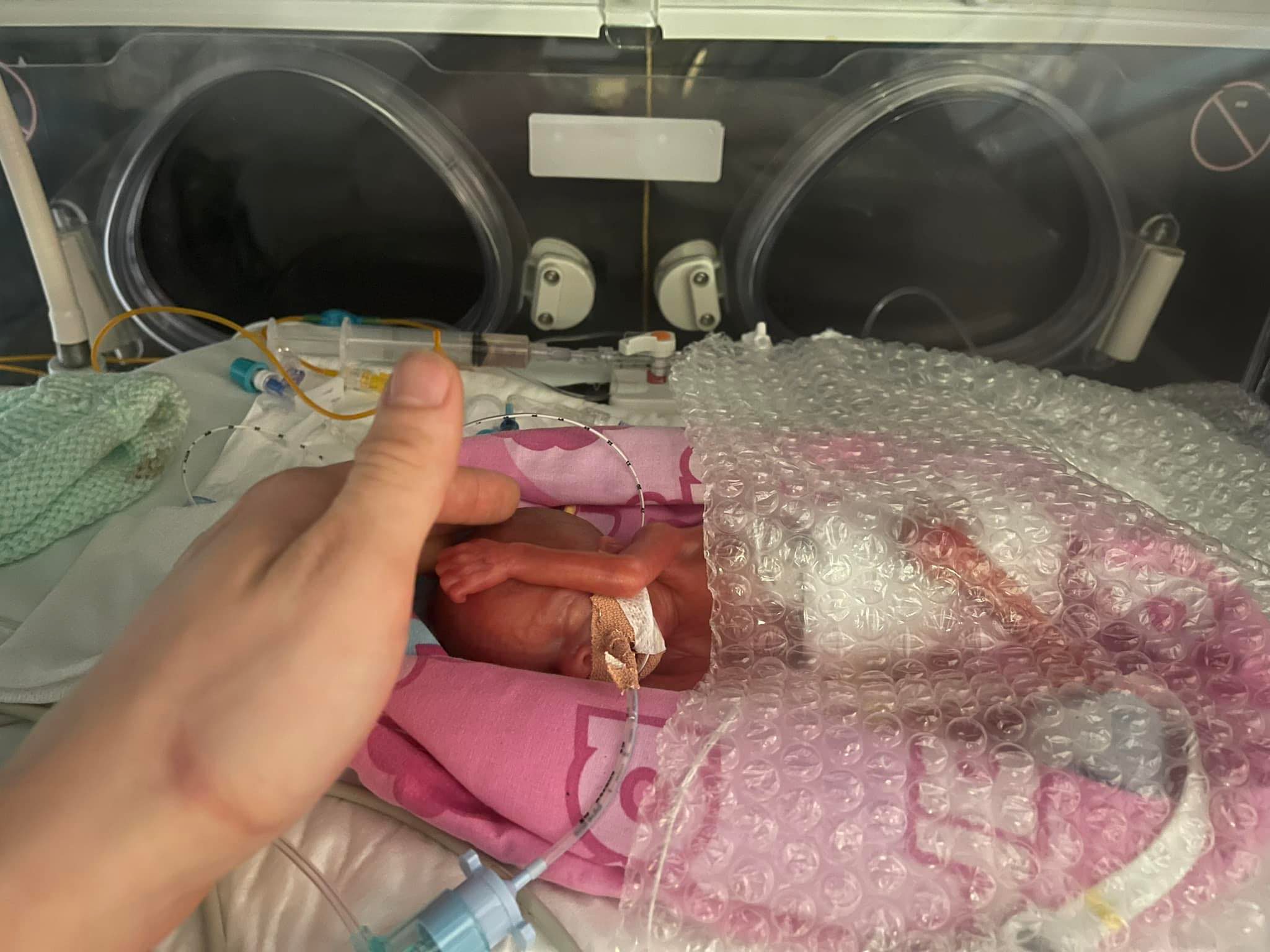 someone's hand gently petting the head of a premature baby named hannah stibbles who is laying in the icu