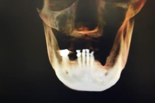 x-ray of Greg's teeth and jaw