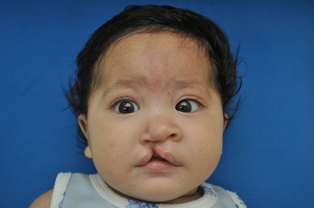 closeup of baby juan before he got cleft care.