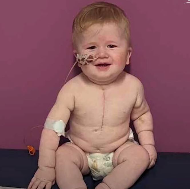 baby Elias showing off his surgical scar from 3 open heart surgeries.