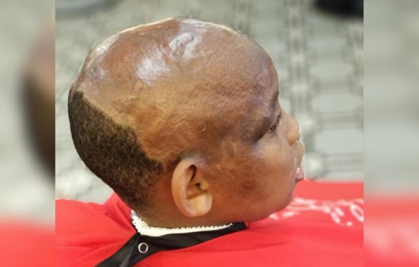 Burn victim Marcel Griffin, Jr. sitting in a barber chair waiting to get a hair unit installed.