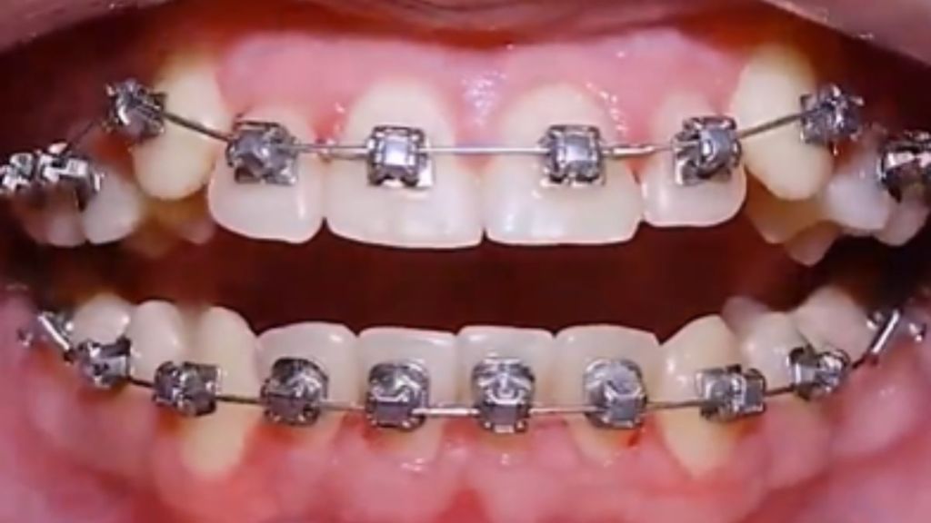 A set of braces straightening teeth.