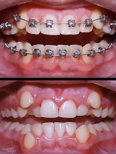 Teeth before and after being straightened with braces.