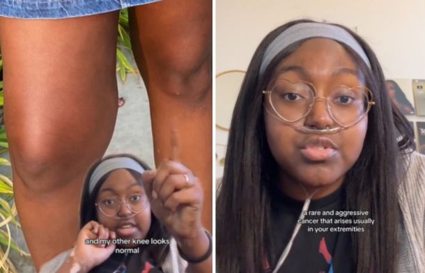 Left image shows a comparison demonstrating the tumor growth in Natasha's right leg. Right image shows Natasha discussing the definition for her type of cancer.