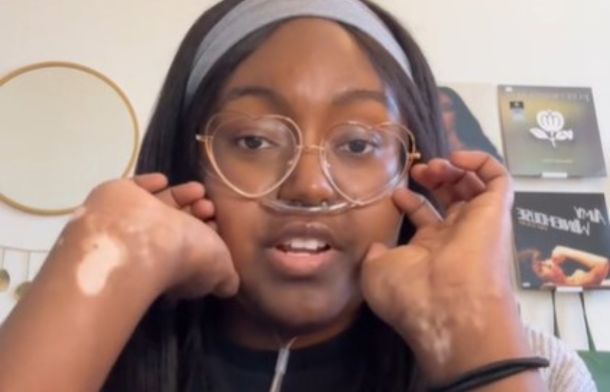 Image shows vitiligo caused as a side effect of one of the treatment programs Natasha was on.